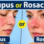 Lupus or Rosacea